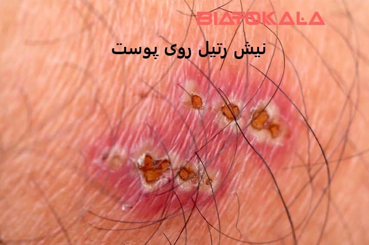 نیش رتیل روی پوست 