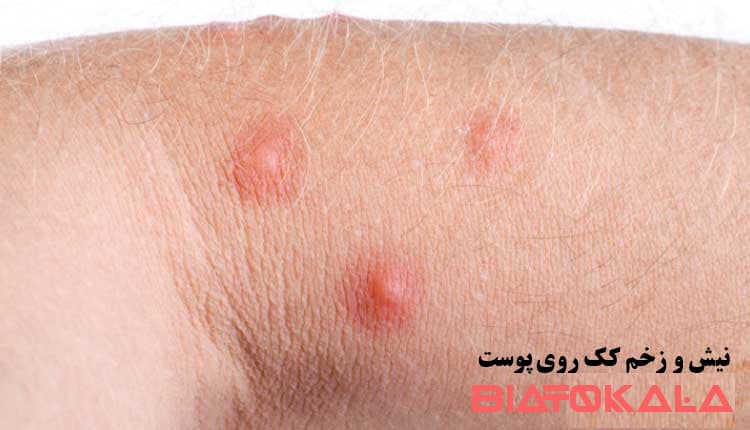 نیش کک روی پوست