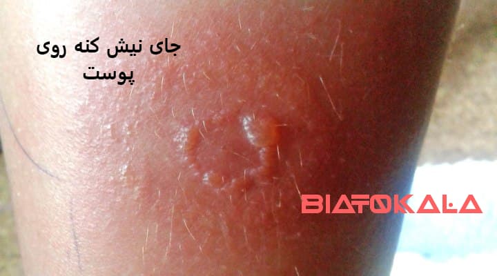 جای نیش کنه روی پوست انسان