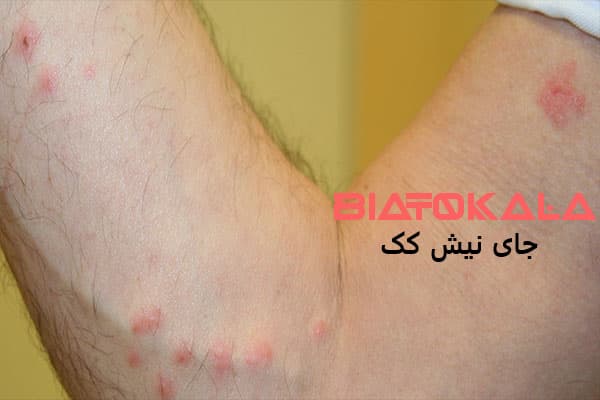 نیش کک روی پوست انسان