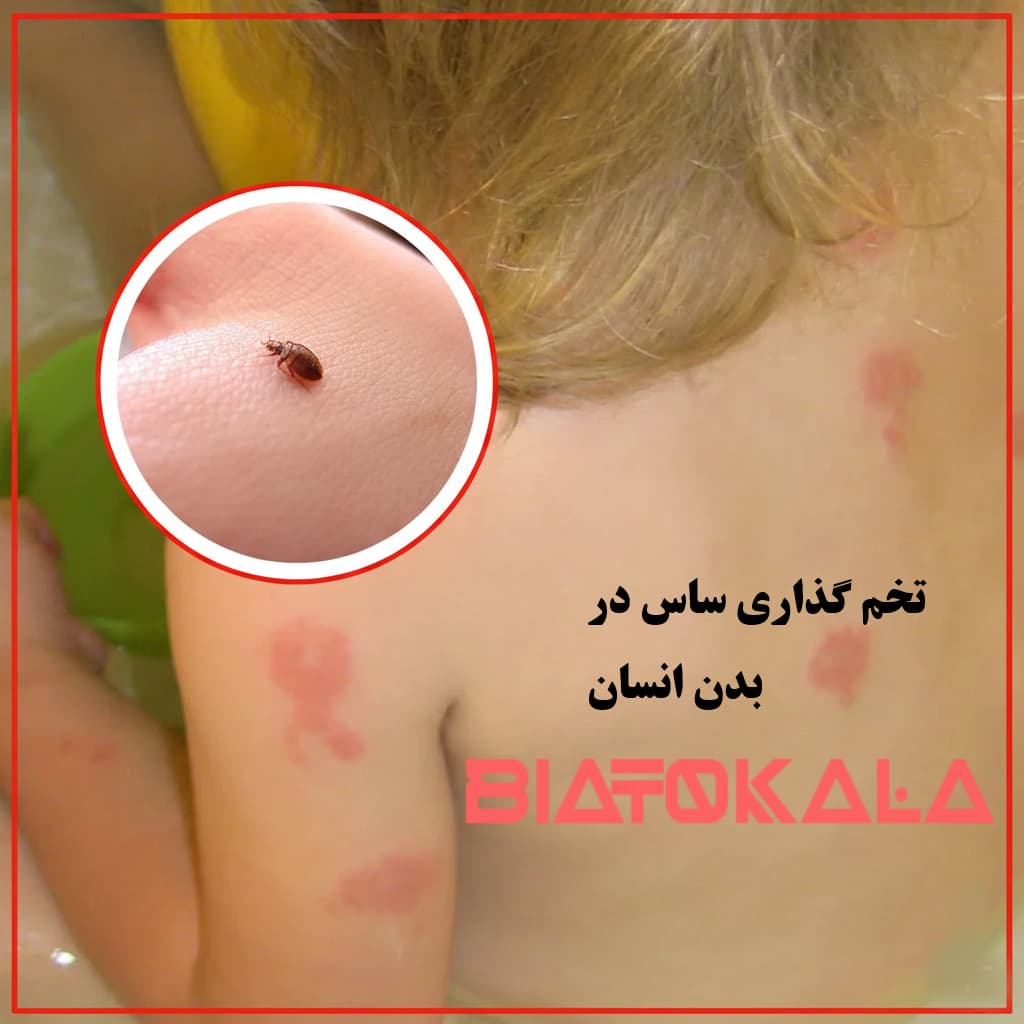 ساس در بدن انسان میتواند رشد کند