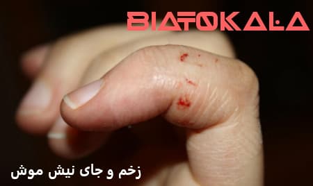 نیش موش در انسان