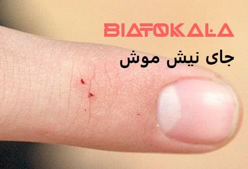 جای نیش موش در انسان