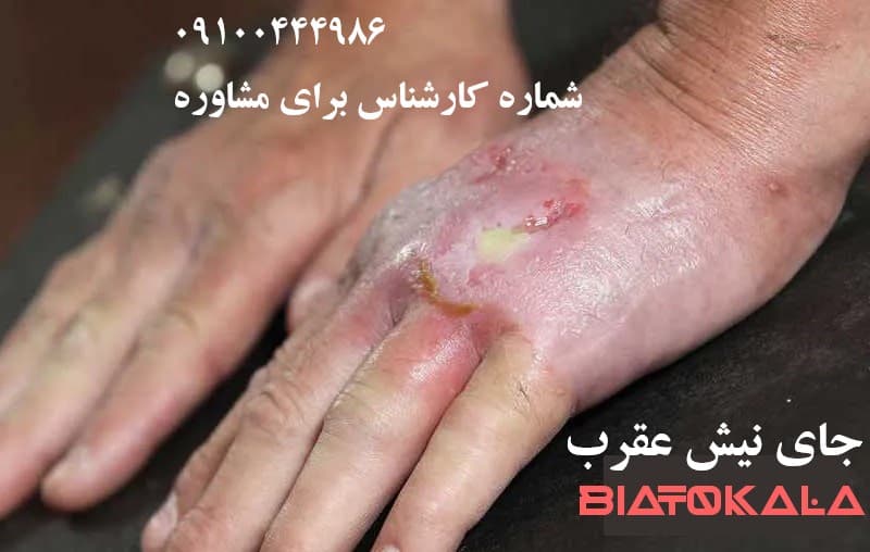 عفونت نیش عقرب در پوست انسان