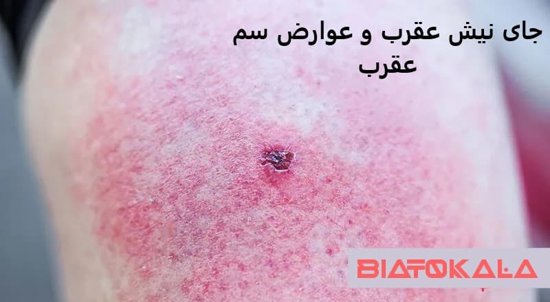 جای نیش عقرب و عوارض سم عقرب