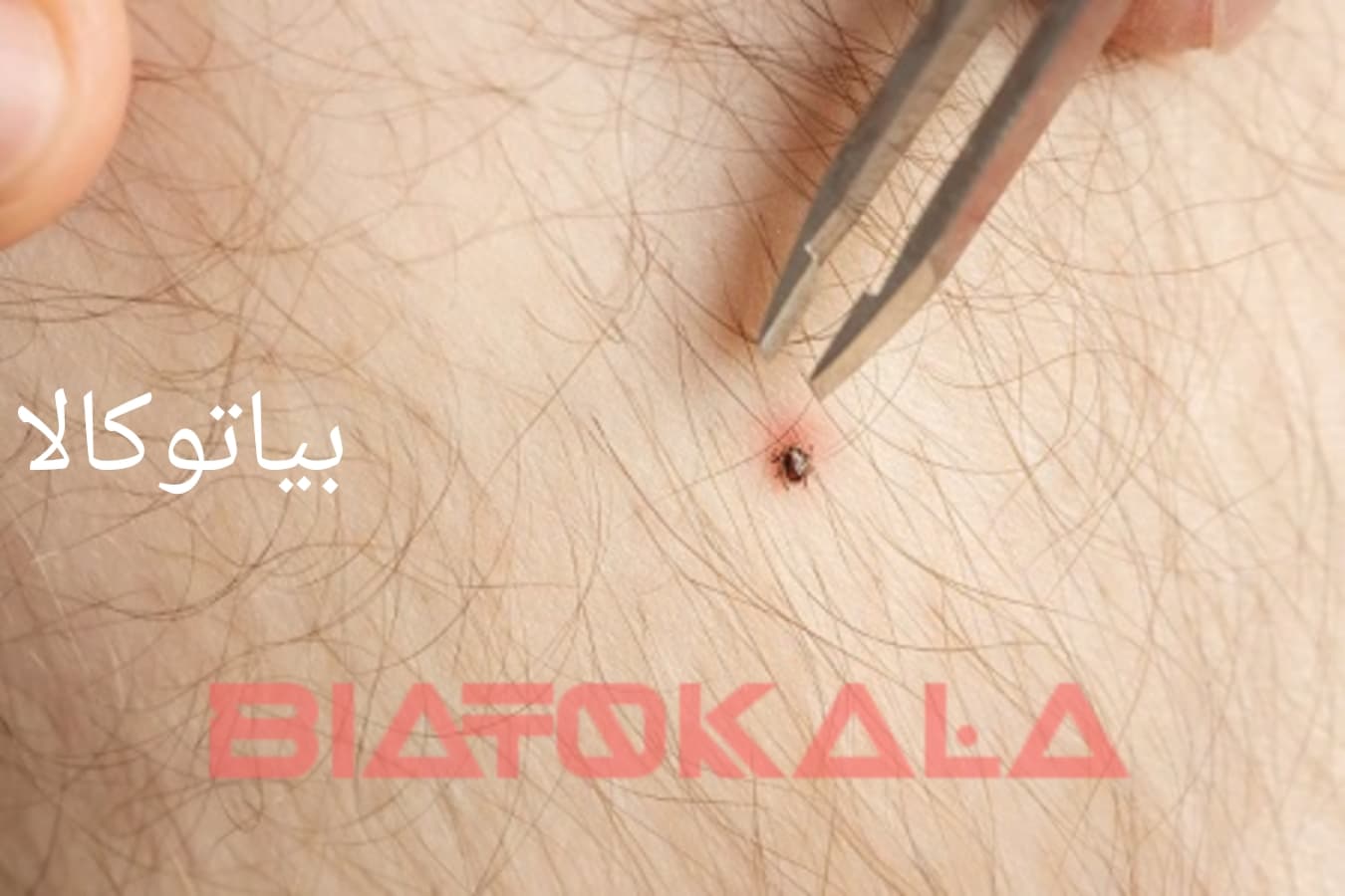 ریشه کنی کنه