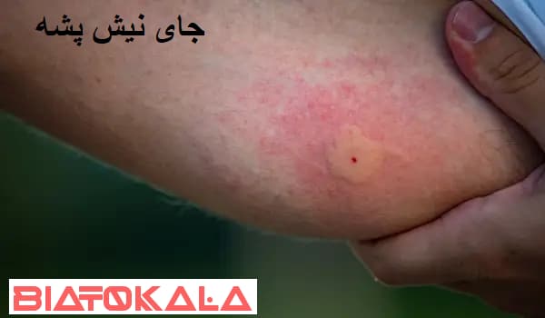 عفونت و باد کردن جای نیش پشه