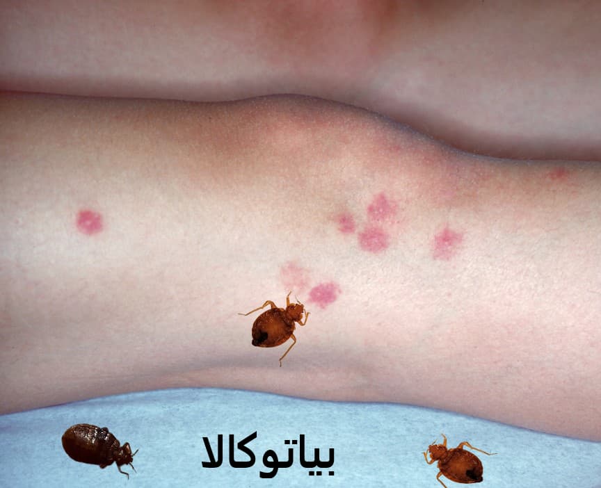 زخم‌های ناشی از خاراندن محل گزش ساس (هشدار پزشکی)