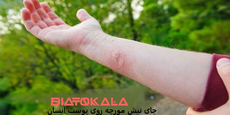 عوارض و زخم جای نیش مورچه