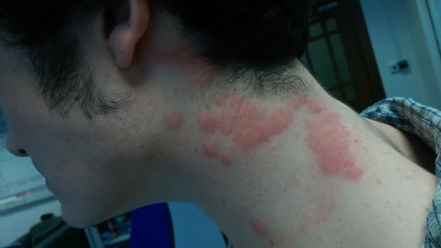 حساسیت به نیش ساس