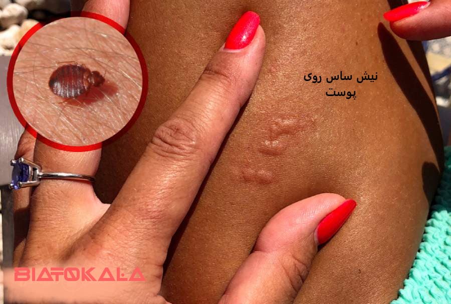 نیش و زخم ساس