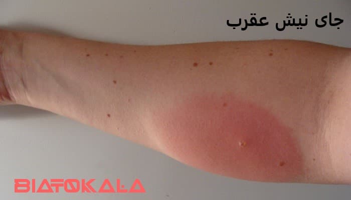 جای نیش عقرب در پوست انسان
