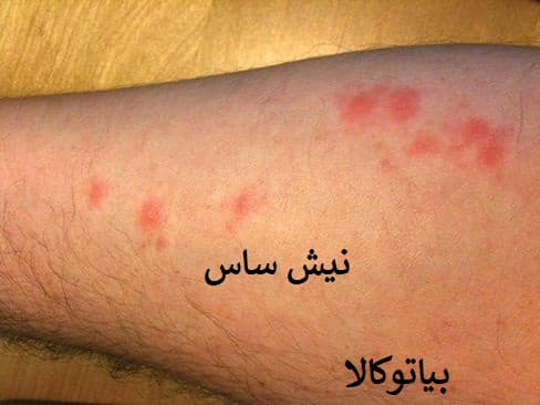 نیش و زخم ساس