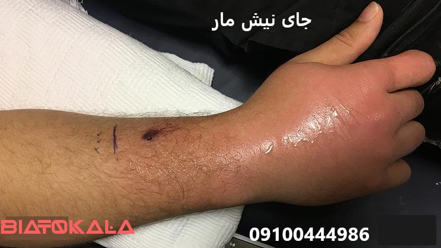 جای نیش مار روی پوست و دست انسان