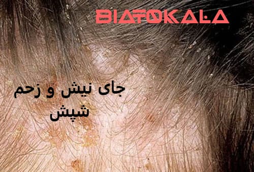 جای نیش و زخم شپش