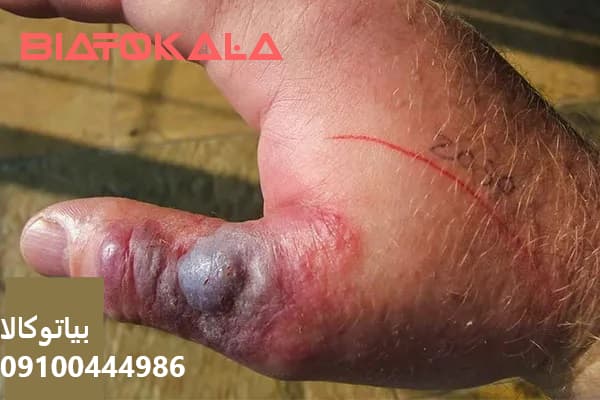 خطرات وسم مار برای پوست 