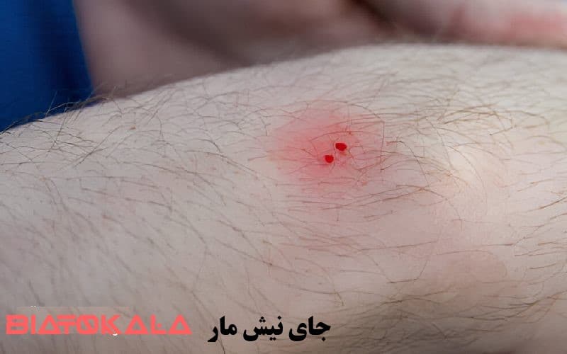جای نیش مار