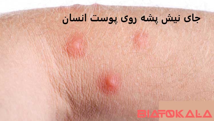 جای نیش پشه و عفونت جای نیش پشه