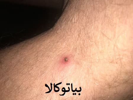 ریشه کنی کنه