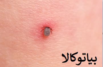 گزش کنه