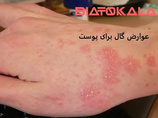 حساسیت و عوارض گال 